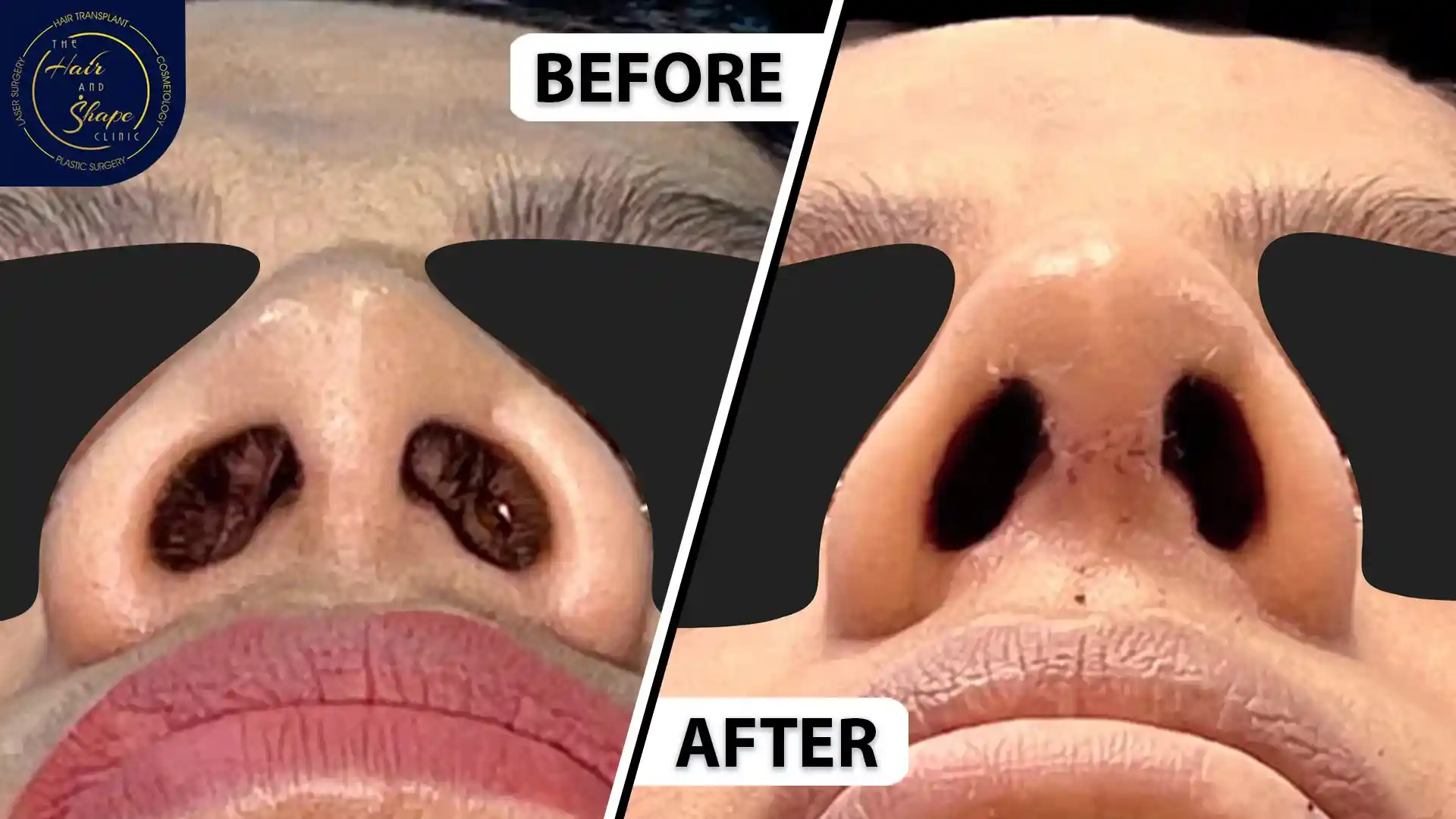 Rhinoplasty result10